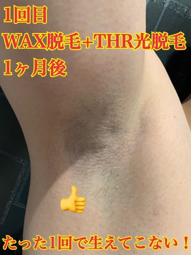 WAX脱毛とTHR光脱毛の併用効果_東京新宿